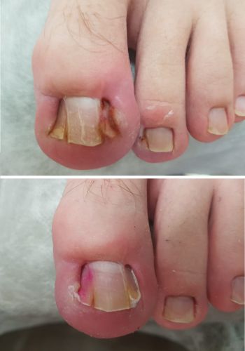Лечение ногтевой пластины