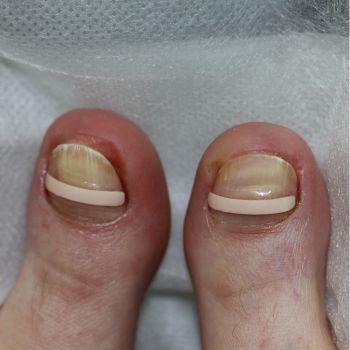 Лечение вросшего ногтя корректирующей пластиной